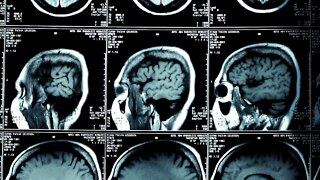 Experts Warn: Medical Bills Could Increase Due To Inflation
