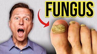 How to Get Rid of Toenail Fungus Fast!