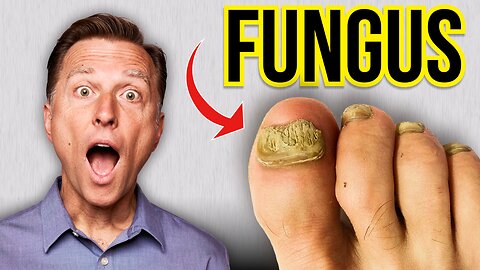 How to Get Rid of Toenail Fungus Fast!