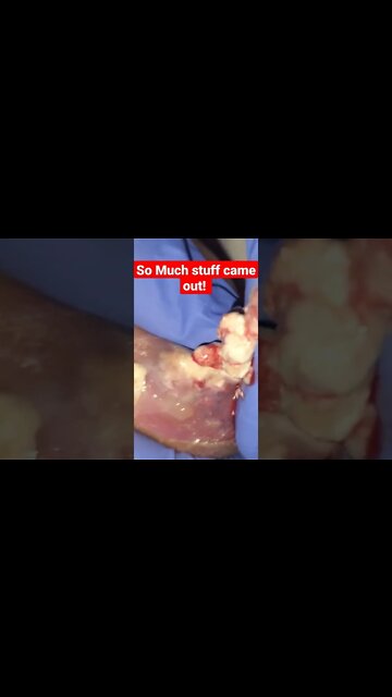 #satisfying #Shorts gout nodule explodes. (can you pray THANKING YESHUA FOR HEALING MY FEET)
