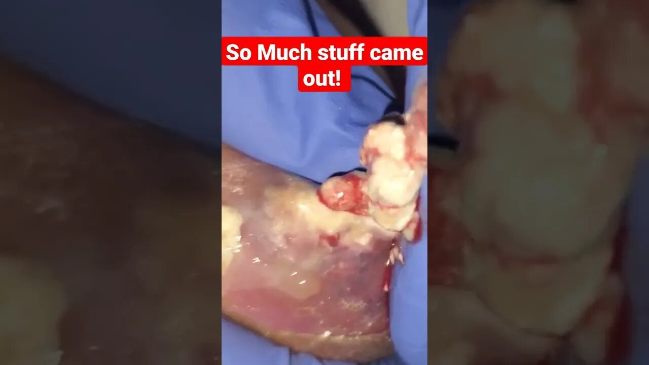 #satisfying #Shorts gout nodule explodes. (can you pray THANKING YESHUA FOR HEALING MY FEET)