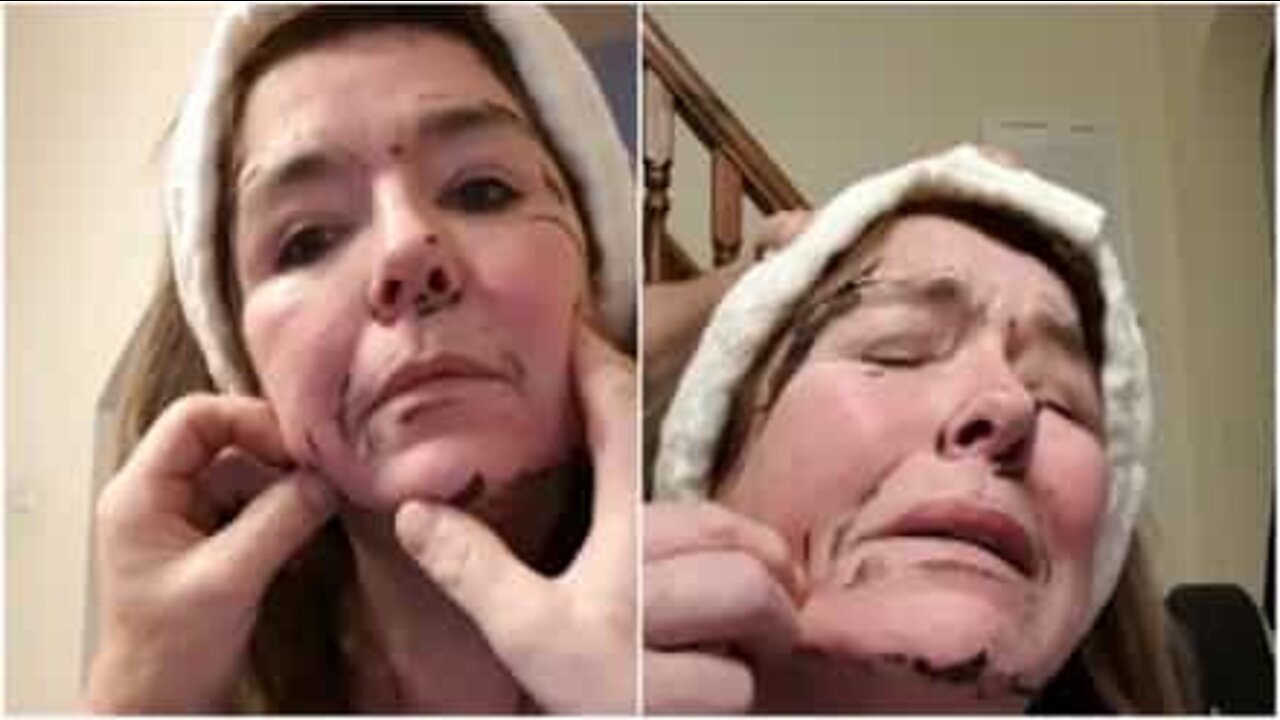 Avó fica com máscara facial presa no rosto