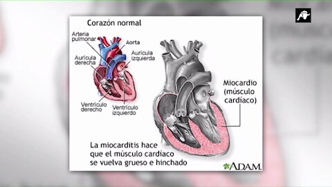 Vivir con Salud: Inflamaciones cardíacas (Miocarditis y Pericarditis)