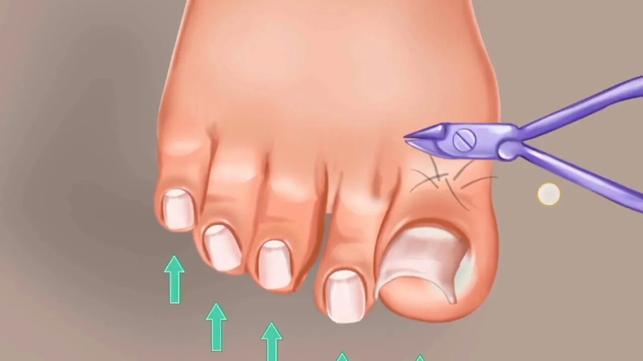 ASMR Toe Nail Operation | @SatisfyingASMRanimations