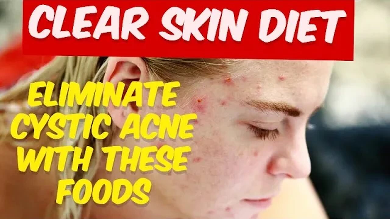 Clear Skin Diet - Naturally Eliminate Cystic Acne with These Foods