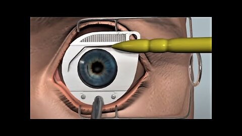 LASIK surgery-3D animation.
