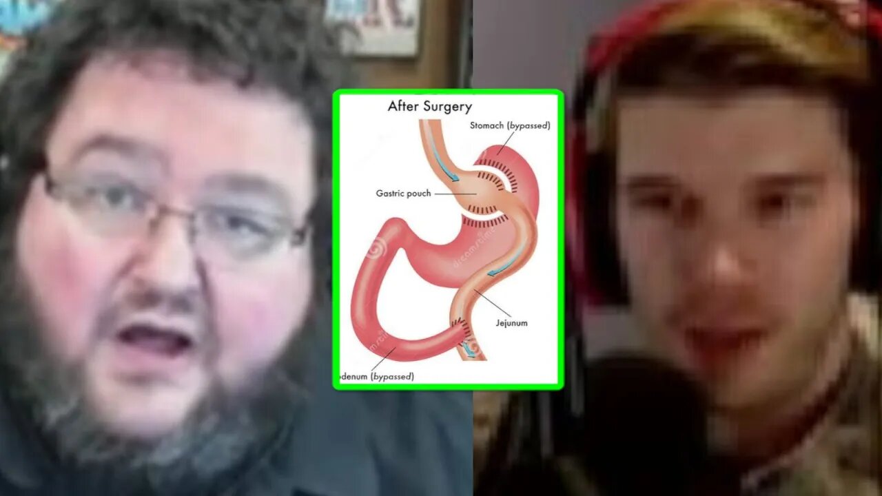 Boogie2988 talks about his weight loss surgery