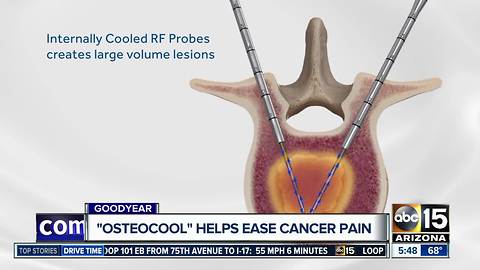 "Osteocool" helping to ease cancer pain