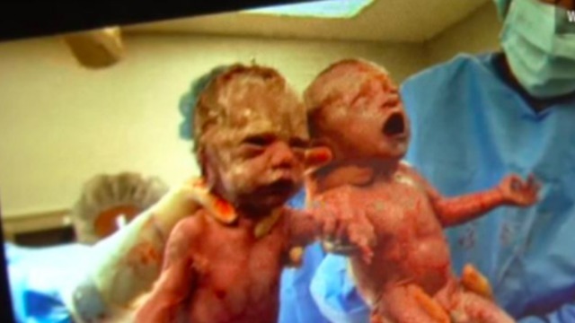 Twins With Rare Condition Born Holding Hands