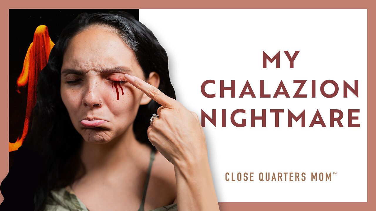 My Chalazion Nightmare