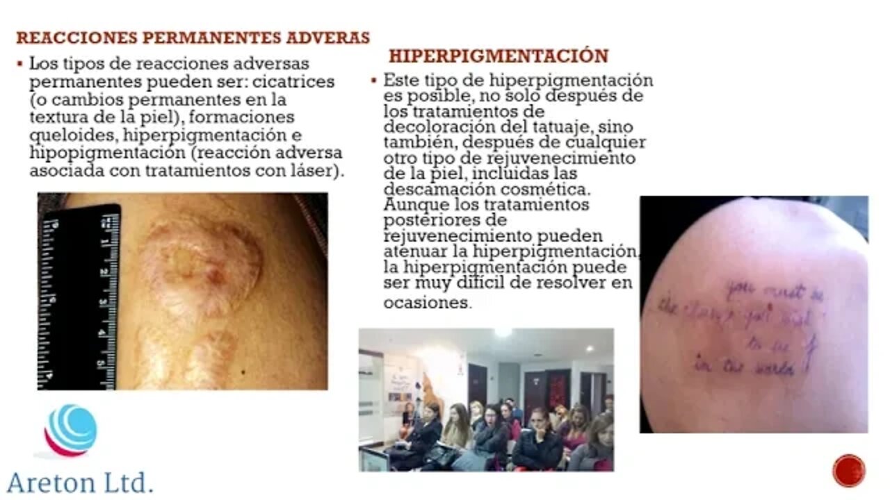 ELIMINACIÓN DE TATUAJES ACTO II