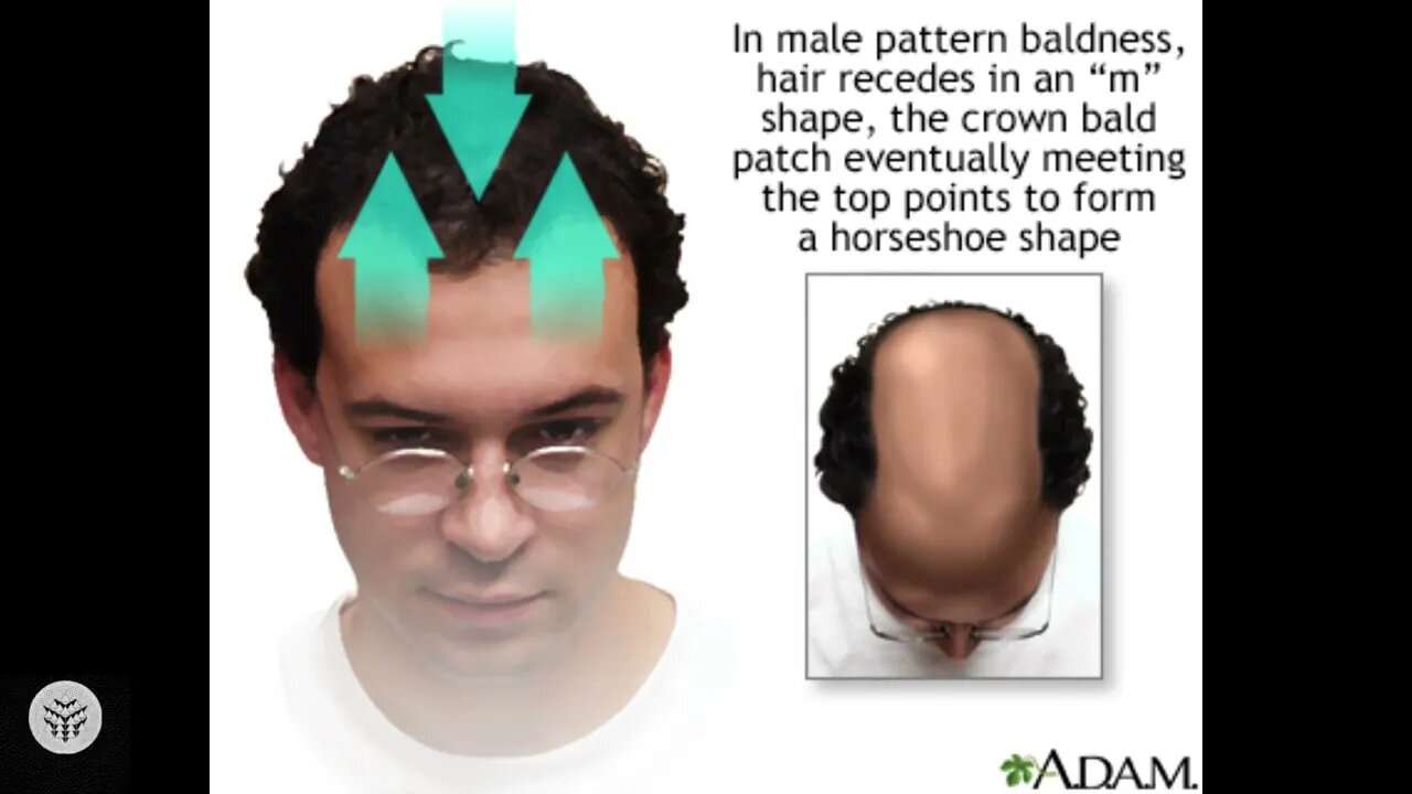 New research leads to new findings on hair loss in men, rare genetic variants discovered