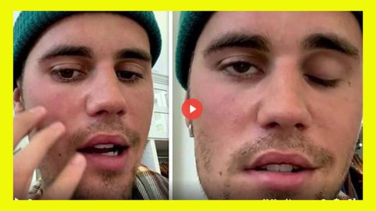 JUSTIN BIEBER STRUCK BY PFIZER FACIAL PARALYSIS & CANCELS SHOWS