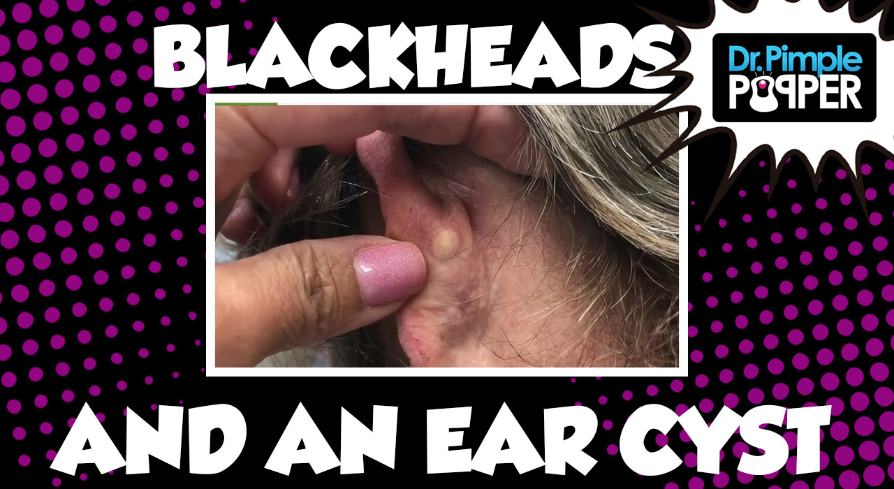 Back Blackheads and an Ear Cyst