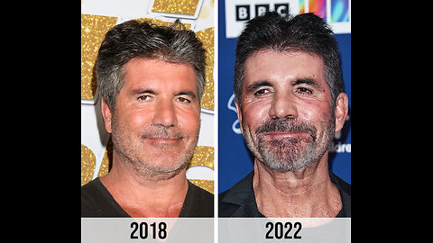 simon Cowell New Face _ Plastic surgery analysis