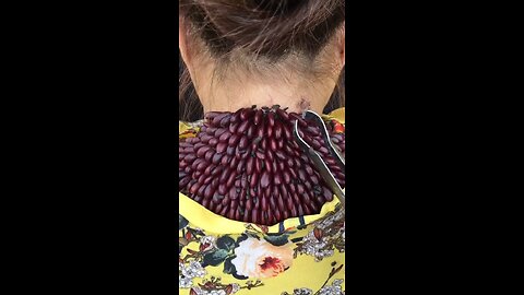 OMG 😱😱 Tick on girl neck