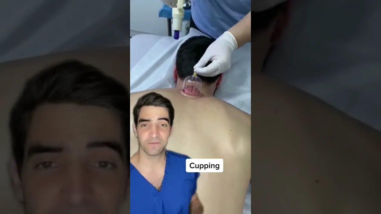 Cupping, does it work?