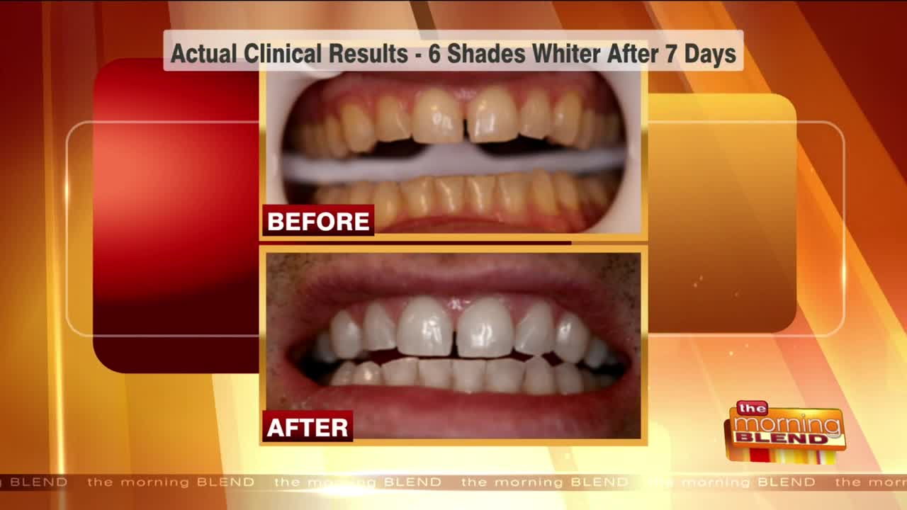 Boost Your Confidence with a Whiter Smile