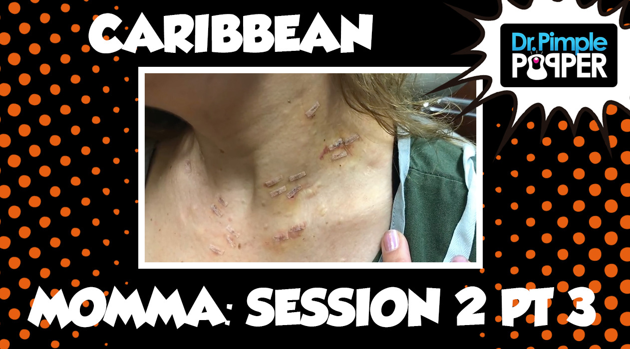 Caribbean Momma and her Steatocystomas: Session Two, Part Three