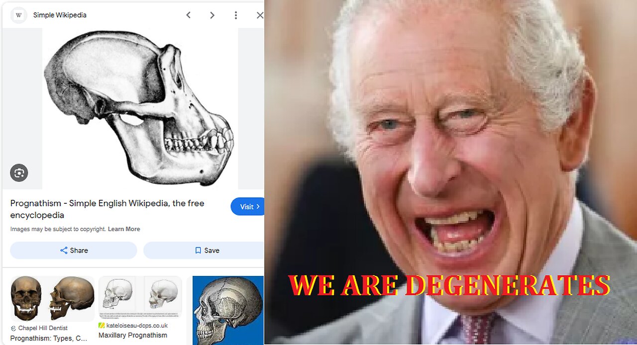 Here is why my teeth had to be destroyed and health ruined HOW SCHIZOPHRENIA WORKS