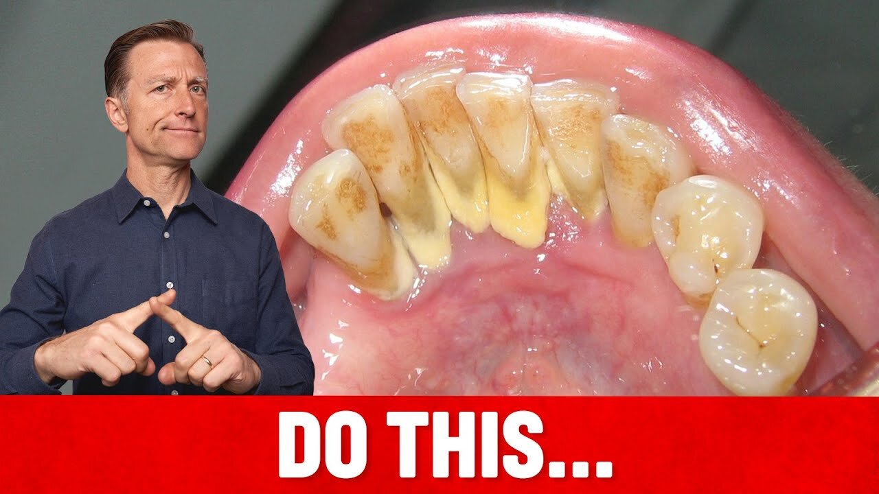 The #1 Top Remedy for Dental Plaque (TARTAR)