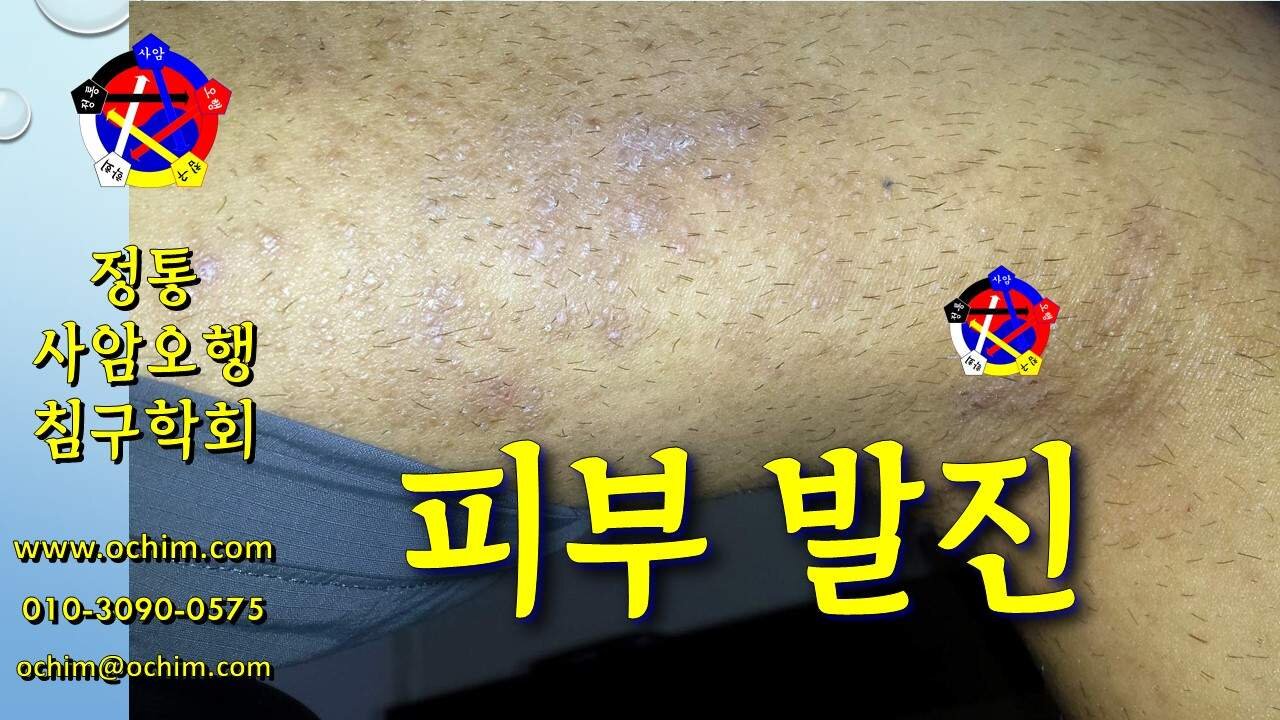 피부발진 치료 방법 및 치료 사례 - 비과학적 양의학 191 - 사암침, 사암침법, 정통사암침