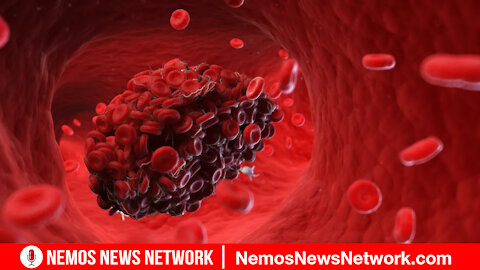 Lethal Blood Clots Develop In 62% of Covid Vaccinated.