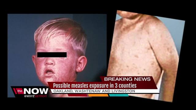 Possible measles exposure in three counties