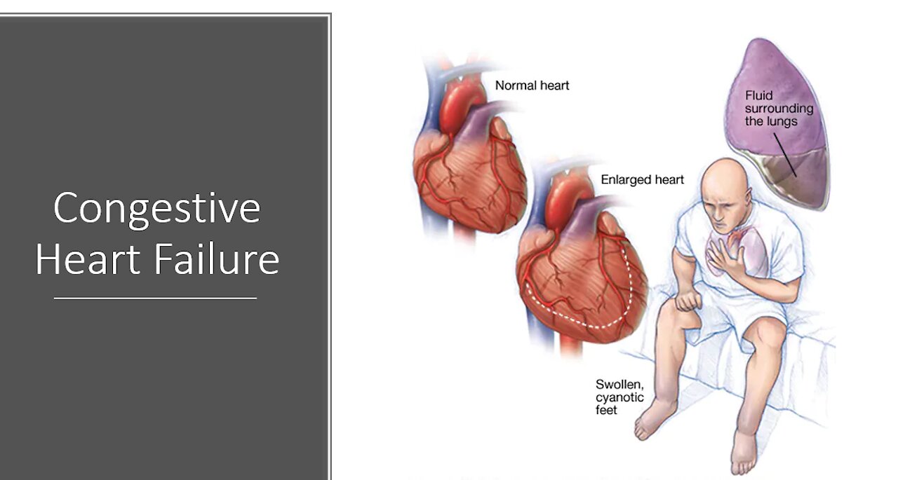 Congestive Heart Failure - Natural Treatment