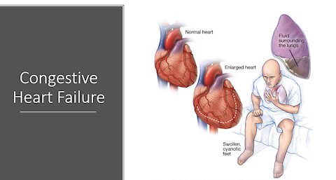 Congestive Heart Failure - Natural Treatment