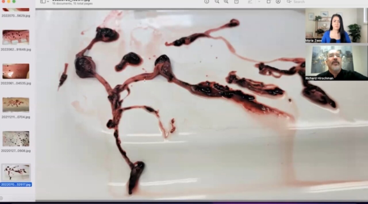 ריצ'רד הירשמן אזהרה גרפי במיוחד מבנים של מיקרו קרישים בזריקה ומוות אחרי שנה מהחיסון