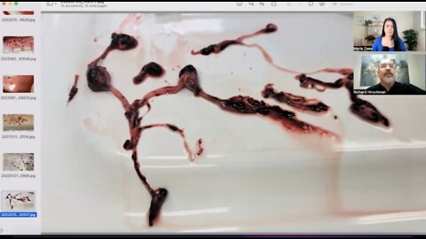 ריצ'רד הירשמן אזהרה גרפי במיוחד מבנים של מיקרו קרישים בזריקה ומוות אחרי שנה מהחיסון