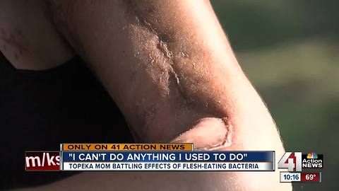 Woman continues fight with flesh-eating bacteria