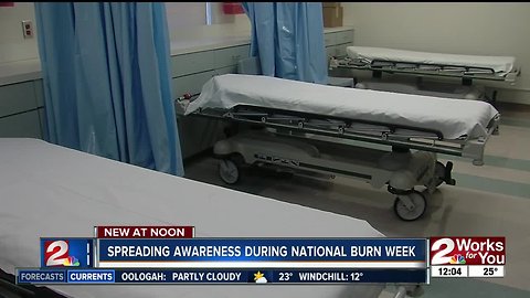 Burn survivor brings awareness to National Burn Week