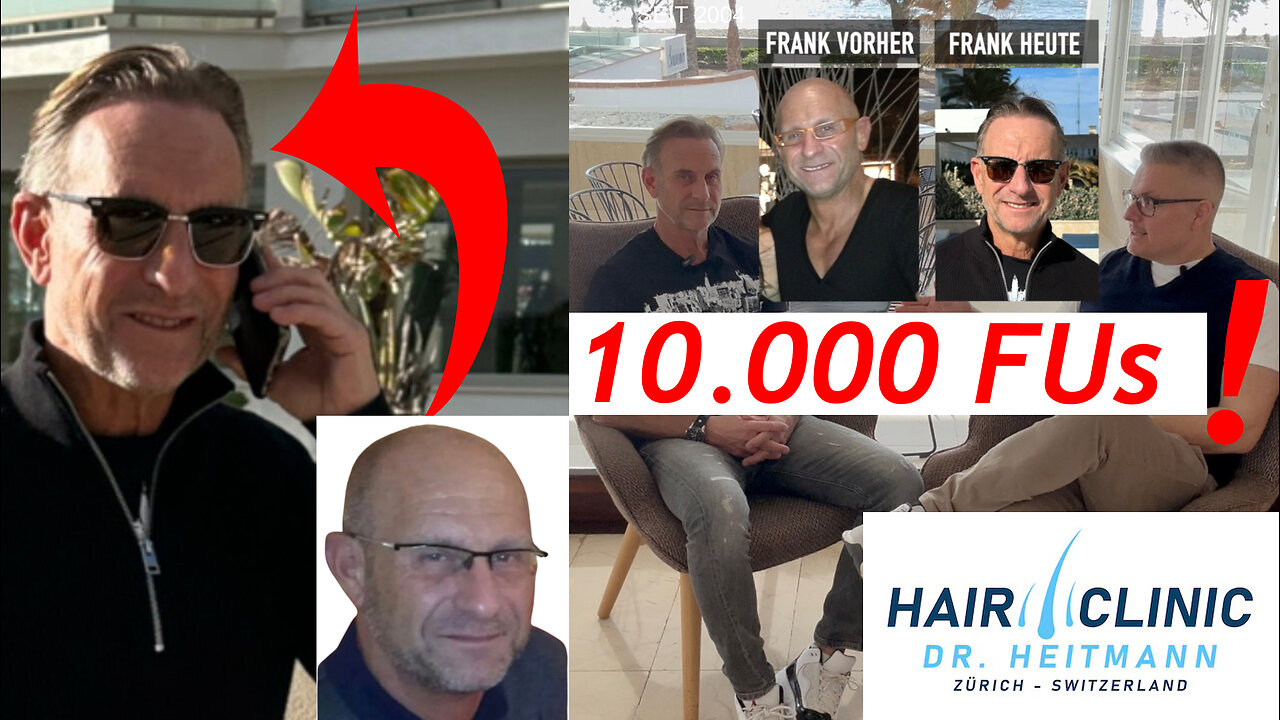 Haartransplantation 🚀 10.000 Grafts Transformation - Von Glatze zur vollen Haarpracht | Mallorca