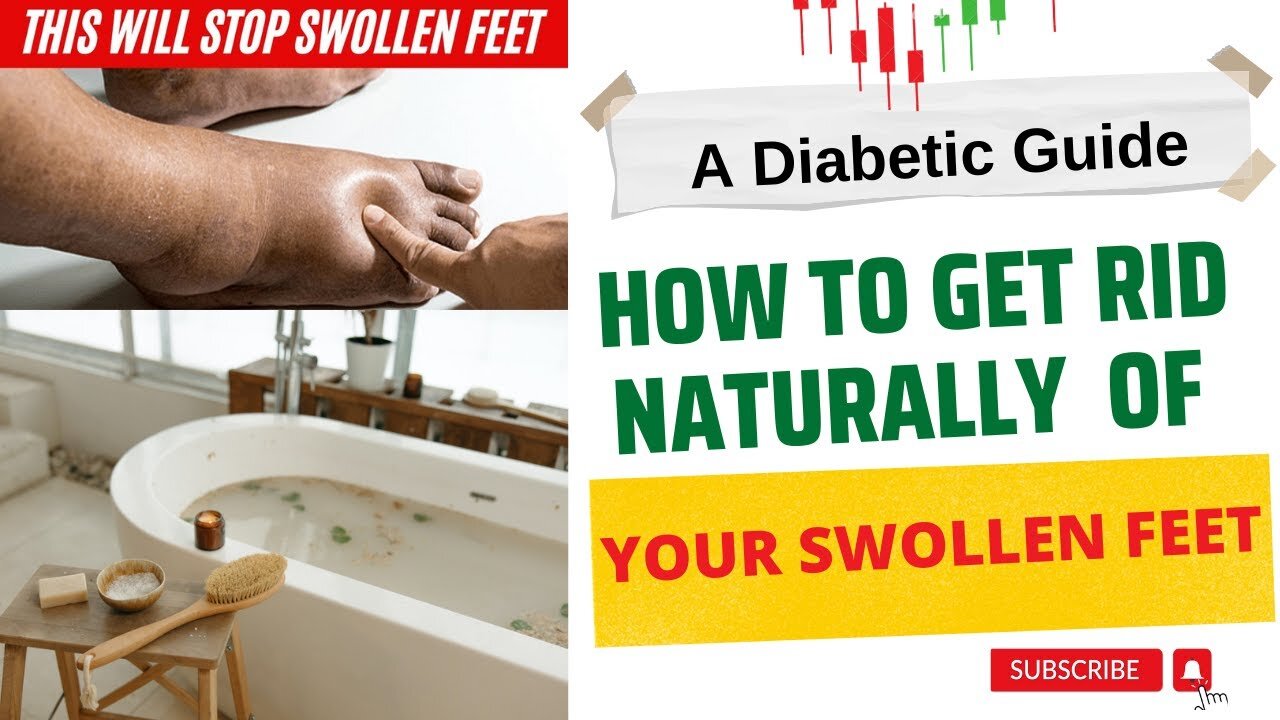 Home Remedies for Swollen Feet | Edema Remedy | Diabetes