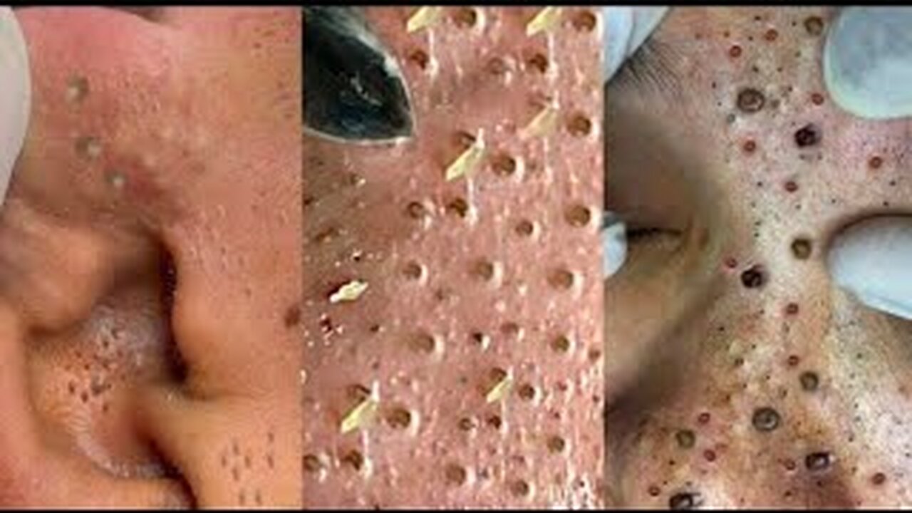 Satisfying Pimple Popping Splinter Blackhead Removing Tiktok compilation 2