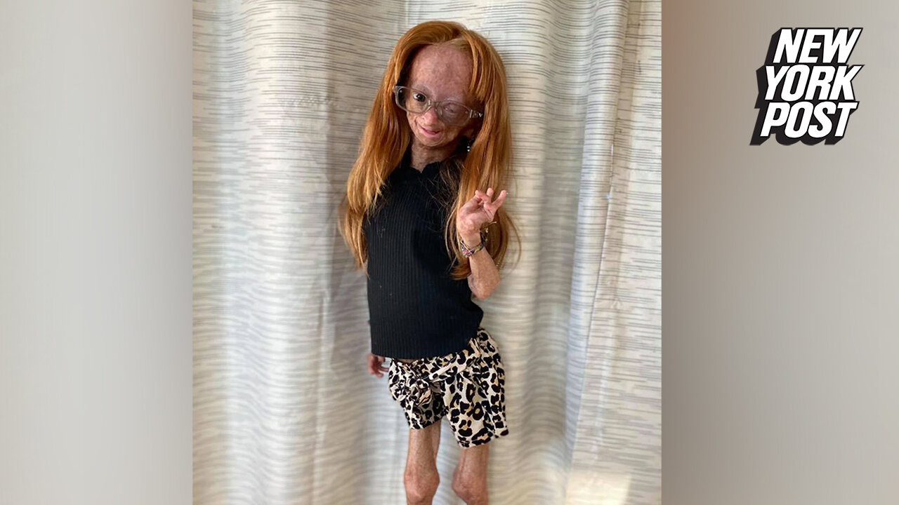YouTuber Adalia Rose Williams dead at 15: 'She is no longer in pain'