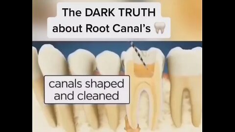 YOUR DENTIST EXPOSED. THE DARK TRUTH ABOUT ROOT CANALS 🦷