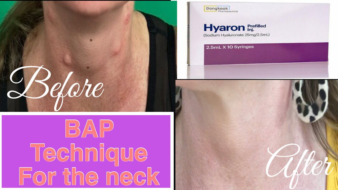 BAP Technique on my Neck with Hyaron