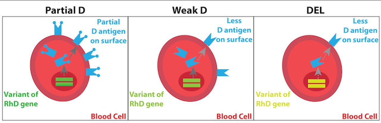 The RH Negative Blood Type: Weak D and Partial D Part 2