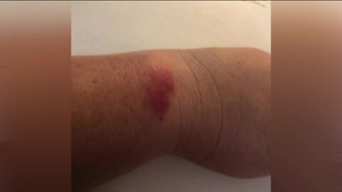 Woman shares photos of burn after recalled Fitbit Smartwatch burned her
