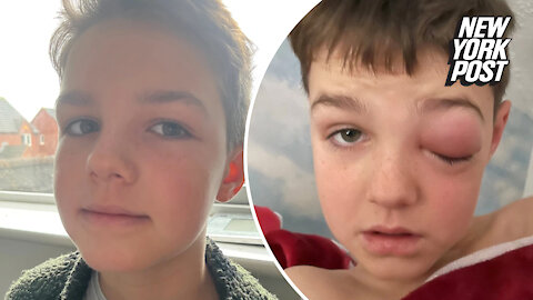 9-year-old nearly goes blind from 'COVID-eye': 'It was going to explode'