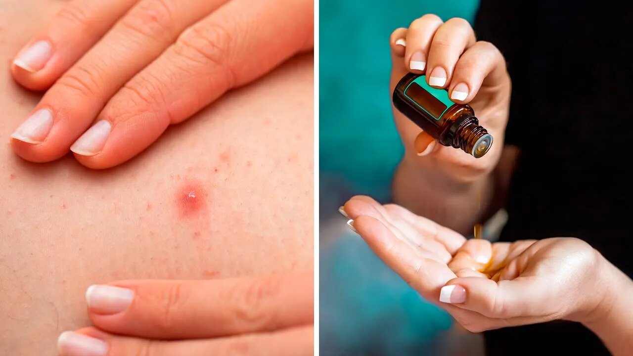 4 FORMA PARA TRATAR A FOLICULITE NATURALMENTE EM CASA