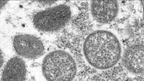 Wisconsin DHS expands monkeypox vaccine eligibility