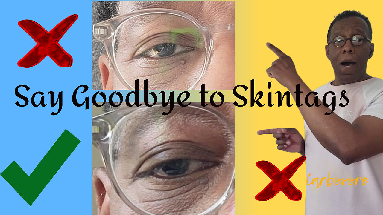 Why do you have "Skin Tags"?