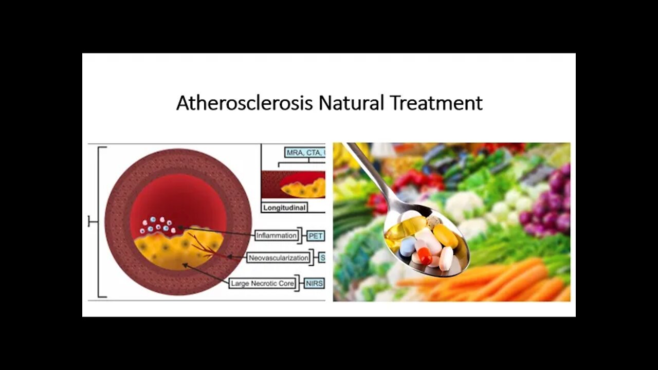 Atherosclerosis Natural Treatment