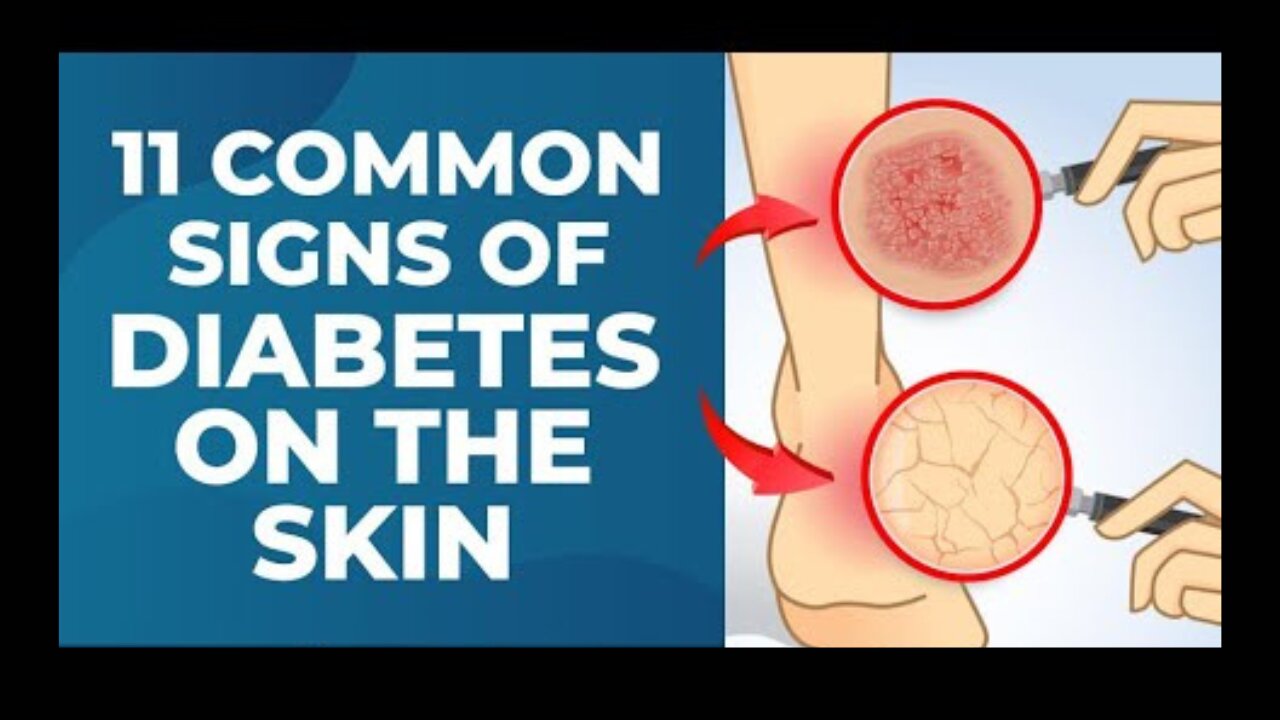 11 Common Signs of Diabetes on The Skin