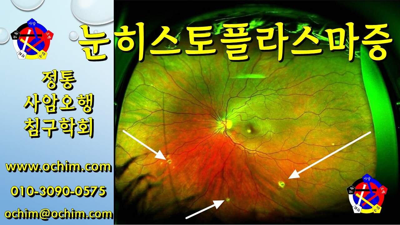 눈히스토플라스마증 치료 방법과 사례 - 사암침법, 사암오행침, 오행침, 정통사암침