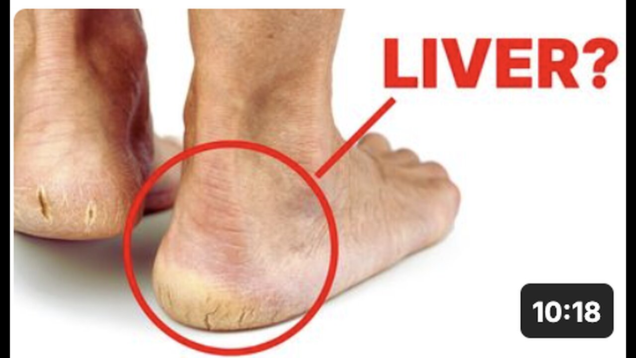 Is Your Liver Crying for Help? Check Your Feet for These Alarming Signs!